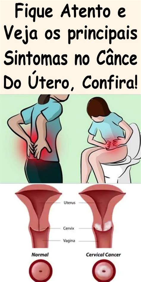 Assim, além de se saber quais os sintomas do câncer de colo do útero. Câncer do Colo do Útero: Sintomas e Sinais da Doença in 2020