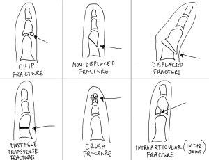 You may also hear the bone break at the time of injury. Types of broken and fractured fingers/toes | Broken toe ...