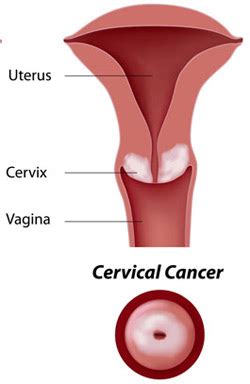 Many people wrongly believe that babies do not notice or remember traumatic events. Cervical Cancer And Pregnancy - Women Fitness