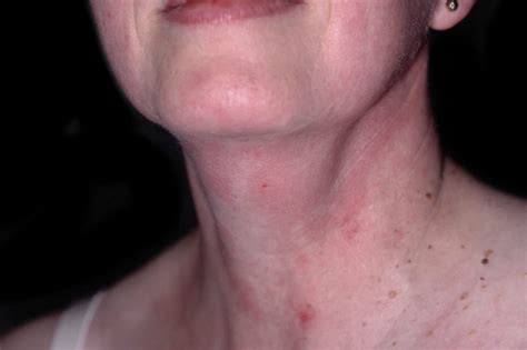 picture-quiz-head-and-neck-swellings-pulse-today