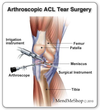Your acl (anterior cruciate ligament) is a tissue band of ligaments that hold the knee bones together. The Medial Collateral Ligament (MCL)