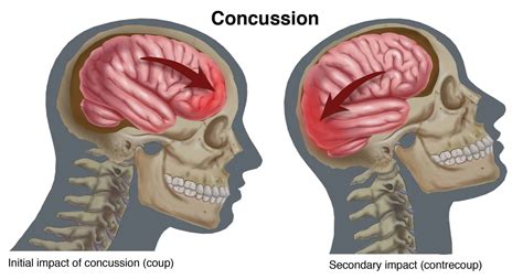 It's Concussion season, how can you prevent a concussion 