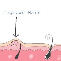 Here, a gynecologist explains how to treat them once and for all. How to remove an ingrown hair on your bikini line ...