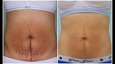 Maybe you would like to learn more about one of these? ELIMINA LAS ESTRÍAS TRATAMIENTO NATURAL, RESULTADOS REALES ...