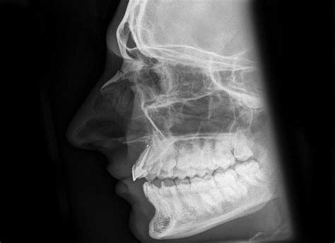 Delee and drez's orthopaedic sports medicine. Definition : Fracture nasal bone (also known as Broken ...