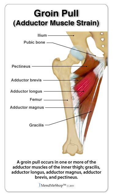 Muscles allow a person to move. groin pull adductor muscle strain volleyball sports injury ...