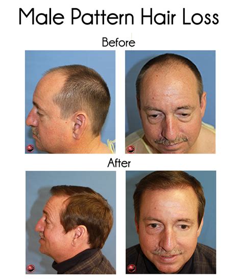 Levothyroxine can cause hair loss t4 only thyroid medications can cause hair loss as a negative side effect of taking the medication. Los Angeles Hair Restoration Clinic Predicts More Hair ...