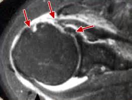 Ces tendons de l'épaule s'usent avec le temps et un excès d'utilisation explique la rhumatologue. Rupture de coiffe des rotateurs de l'épaule, Paris - Tunisie