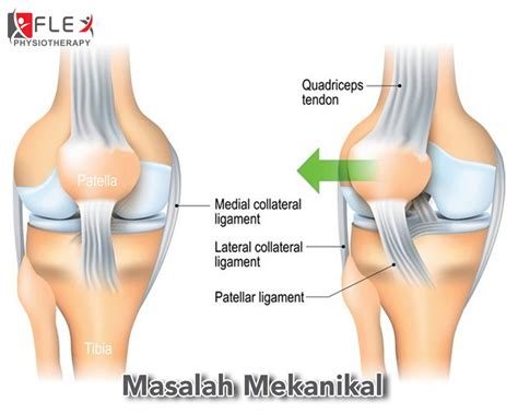 Jenis dan punca kepada masalah lutut berbunyi. Sakit Lutut : Punca, Simptom dan Rawatan Fisioterapi ...
