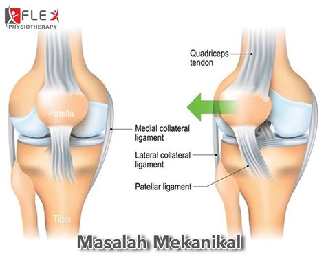 Patang/retak tulang dibahagian lutut akan menjejaskan fungsi lutut serta mendatangkan kesan menyakitkan ketika menampung berat. Sakit Lutut : Punca, Simptom dan Rawatan Fisioterapi ...