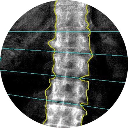 A bone density scan is used to: Bone Density Scan | Rolling Oaks Radiology