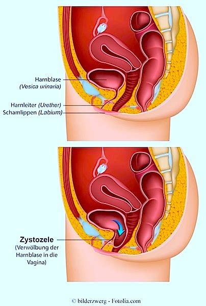 Was man bei innerer leere nicht tun sollte. Blasenvorfall, Zystozele, Blasenprolaps, Symptome ...