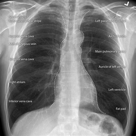 The chest or thorax is the region between the neck and diaphragm that encloses organs, such as the heart, lungs, esophagus, trachea, and thoracic diaphragm. Cardiomediastinal outlines on chest x-ray | Image ...