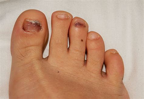 Also, it takes time to deal with nail fungus completely, so this is not a disease that you can eliminate. Toe Nails Fungus Treatment in Melbourne , VIC - Bay ...