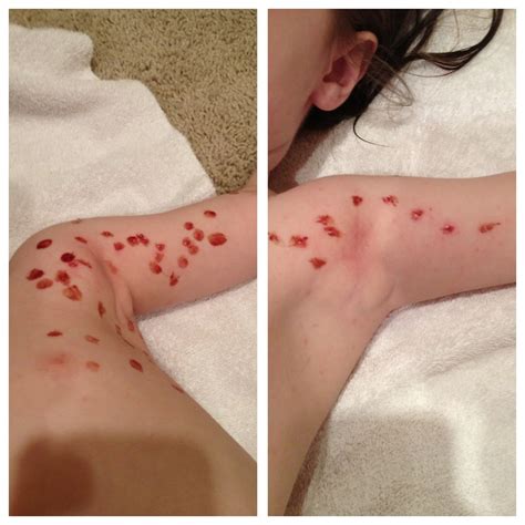 However, it's common for the condition to spread around the body, so it can take up to 18 months or more for the condition to clear completely. The Averitt Fam: Molluscum Contagiosum...