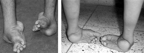 Clubfoot is a birth defect where one or both feet are rotated inward and downward. Clubfoot - OrthoInfo - AAOS