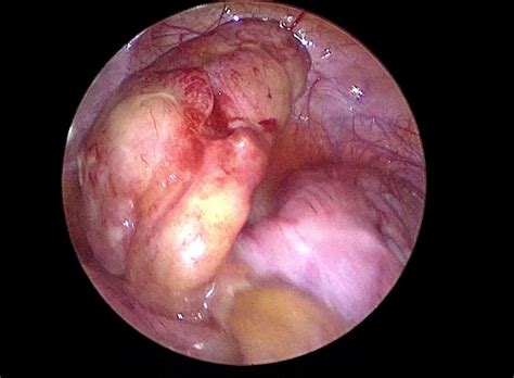 Bahagian usus besar tersebut dipanggil sebagai 'cecum'. Appendicitis pada kanak-kanak - apakah itu dan bagaimana ...