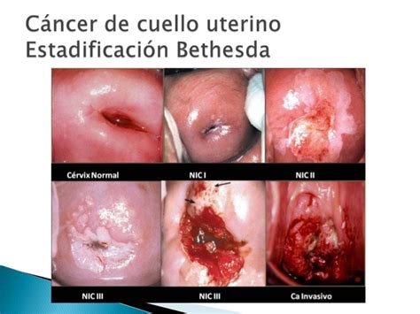 ¿cuáles son algunos de los sistemas de gradación específicos al tipo de cáncer? Cáncer de cuello uterino