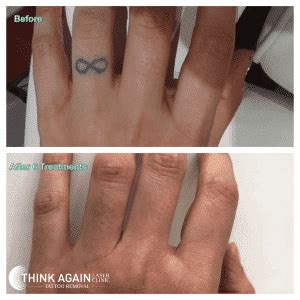 Does tattoo removal cream work? How Many Laser Tattoo Removal Treatments will I Need?
