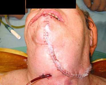 When head and neck cancer is diagnosed, what stage is it typically at? Untitled Document www.uwo.ca