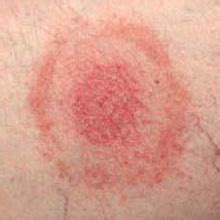 If no tick body parts are stuck under the skin, the itch usually is gone in under a week. What do Tick Bites Look Like - Tick Bite Pictures