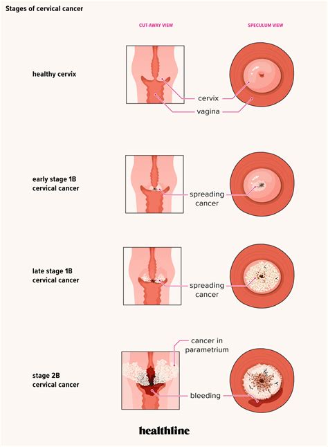 Vaginal malignancy is usually metastatic, and less commonly primary, in origin. Helminth definition in medical,