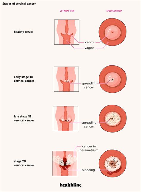 The stage of a cancer is based on how big a tumor is and whether it has spread. Helminth definition in medical,
