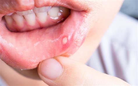 My cold sores can be suddenly done, it is a cumbersome symptom. Mouth Sores - Polished Family Dental