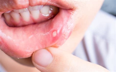 Mouth sores are common ailments that affect very many people in the world at some point in their lives. Crucial Facts About Canker Sores | Karoku