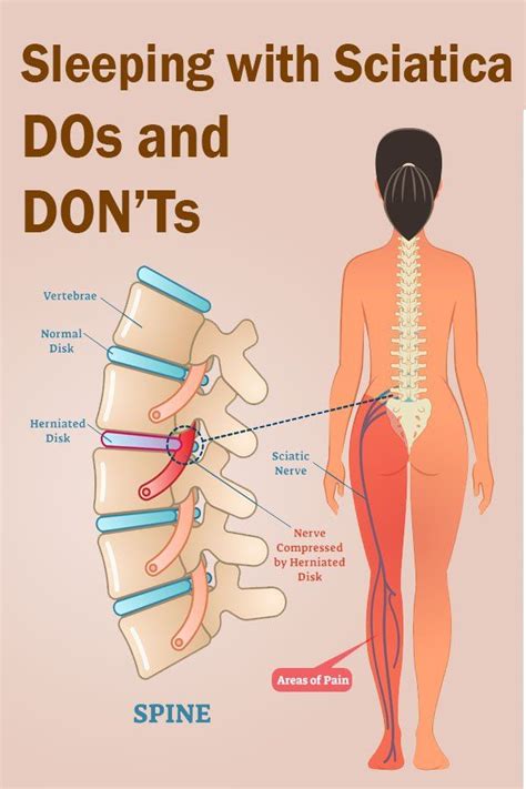 Certain sleeping positions can help ease your back pain, so find one that is most comfortable for you. Best Sleeping Position For Herniated Disc - Aline Art