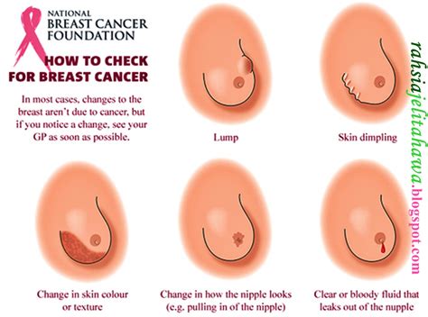 Tahap 1 pada peringkat ini, ketumbuhan barah adalah dalam ukuran sebesar 2 cm ataupun kurang daripadanya. Risiko Kanser Payudara - Rahsia Jelita Hawa | Agen Top ...