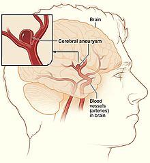 Office of communications and public liaison national institute of neurological disorders and stroke national institutes of health bethesda, md 20892. Aneurisma cerebral - Wikipedia, la enciclopedia libre