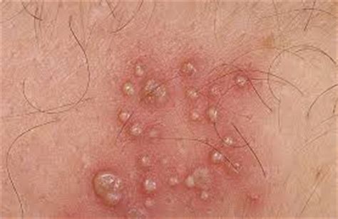 Ingrown hairs occur when hair curls around and grows back into the skin or if dead skin clogs the hair follicle and forces it to grow sideways. Ingrown hair | Israel| PDF | PPT| Case Reports | Symptoms ...