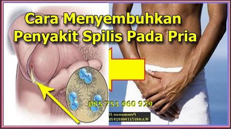 0877 3652 7305, dan tunggu respon cs kami. PENYAKIT SPILIS : Cara Menyembuhkan Penyakit Spilis Pada ...