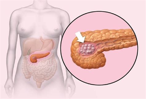 Pancreatic cancer is a cancer that's found anywhere in the pancreas. 8 أعشاب مفيدة جداً لصحة البنكرياس، العضو الذي يسبب الخلل ...