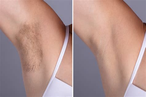 Laser hair removal can be dangerous in inexperienced hands. IPL and Laser Hair Removal - About Andresa
