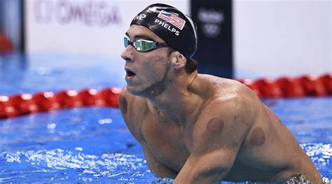 Athletes are using cupping in the 2016 olympics in rio. What is cupping? Controversial therapy dominating Rio ...