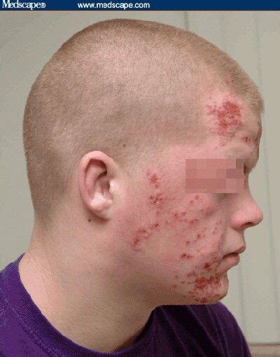 Human herpes virus 1 human herpes virus 1 (hhv1) is also known as herpes simplex virus 1 (hsv1). Pin on Rashes