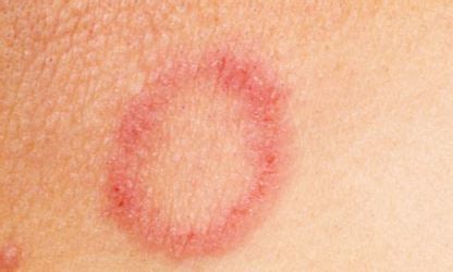 The rash can start from a localized part then gently spread to other parts when not properly. Ringworm causes red rashes that are circular and can be ...