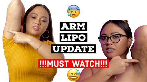 Everything you need for a bbl lipo360 and tummytuck bbl mommymakeover. MUST WATCH ARM LIPO UPDATE | BBL ARM & CHIN LIPO | SURGERY ...