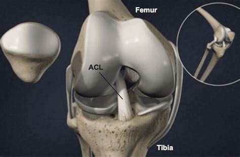 It can happen to athletes who play sports like football, basketball, soccer and volleyball. Anterior Cruciate Ligament - ACL Tear | Symptoms ...