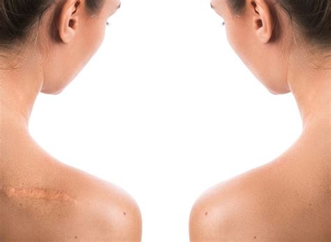 How to get rid of burn scars? How To Get Rid Of Scars - RandomHealthNet.com
