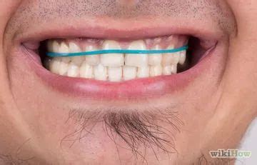 Depending on your orthodontic problem, your dentist should be able to select the best solution to straighten out your teeth without braces. How to Straighten Your Teeth Without Braces | Diy teeth ...