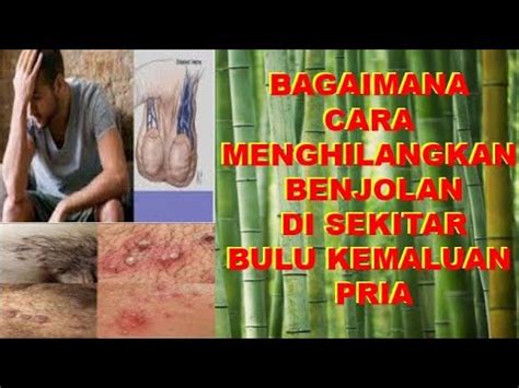 Banyak perempuan yang memilih untuk merapikan area kewanitaan dengan menghilangkan bulunya. BAGAIMANA CARA MENGHILANGKAN BENJOLAN DI SEKITAR BULU ...
