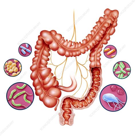 They're often caused by a stomach bug and should stop in a few days. Diarrhoea, artwork - Stock Image - M140/0283 - Science ...