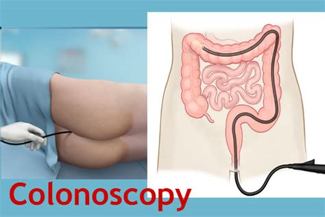 Learn more about what to expect before, during, and after a colonoscopy and how to prepare. 25 Valuable Pros and Cons of Colonoscopy Treatment