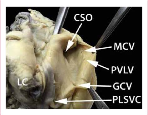 The great cardiac vein ascends in the anterior interventricular groove, alongside the interventricular branch of the left coronary artery. View of the internal surface of the ostia of the coronary ...
