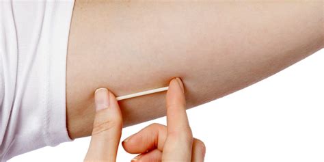 Common questions about the birth control implant answered. Birth Control Implant: Cost, Effectiveness, Side Effects ...