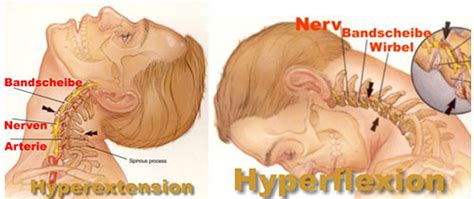 Schleudertrauma ist an sich keine medizinische diagnose, sondern eine beschreibung des unfallmechanismus. Das Schleudertrauma | Rainer Dallmann Rücken-Notruf