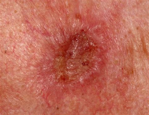 Squamous Cell Carcinoma Skin Cancer Questions Answered » Scary Symptoms
